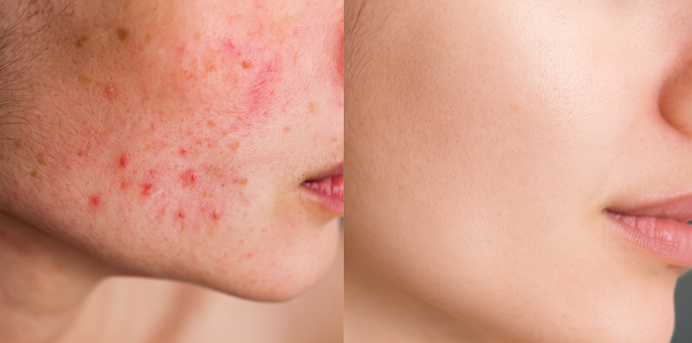 ニキビ改善の前後