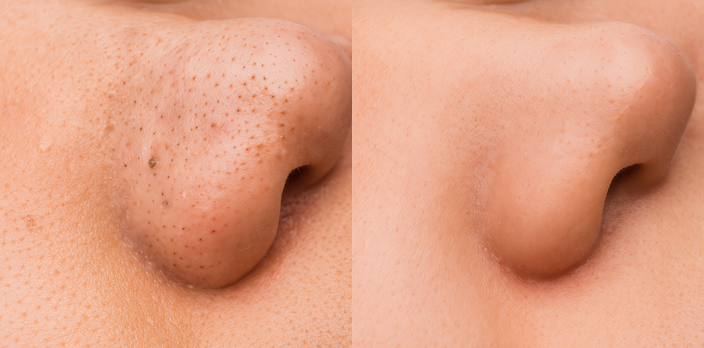 ブラックヘッド改善の前後